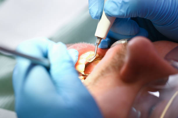 Best Emergency Tooth Extraction in Addison, WV
