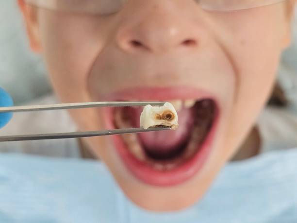 Best Emergency Treatment for Dental Infections or Abscesses in Addison, WV